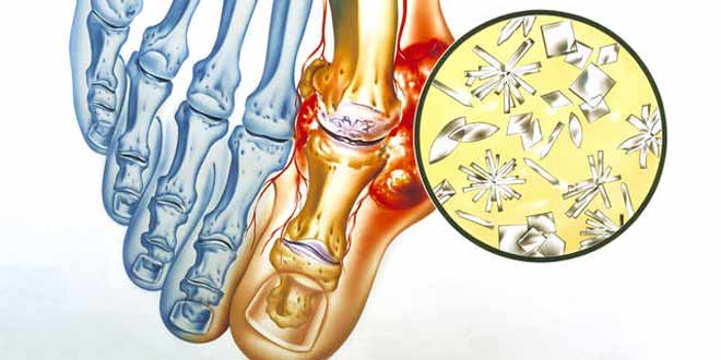 نقرس و روش های درمان آن : وجود اسید اوریک زیاد در بدن باعث تشکیل کریستال های ریزی در مفاصل می شود که با درد شدید همراه است که به آن نقرس می گویند