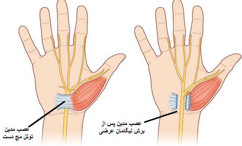 ازاد سازی عصب مدین با جراحی CTS