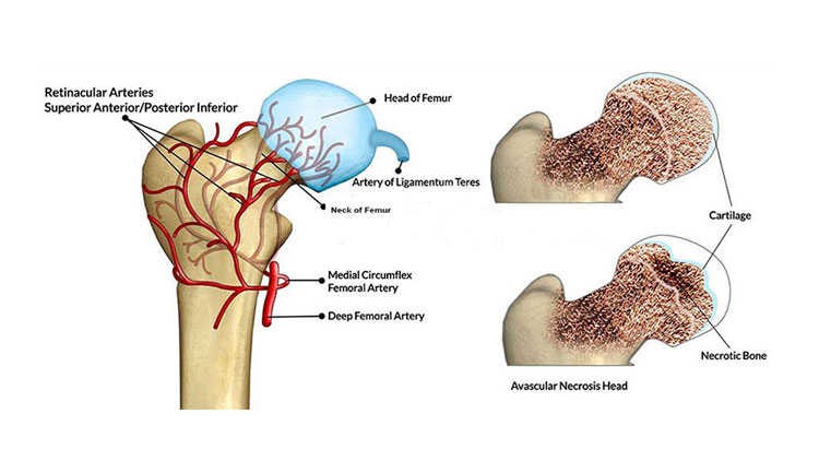 نکروز آواسکولار یا استئونکروز 1