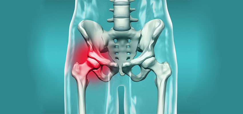 نکروز آواسکولار یا استئونکروز 3