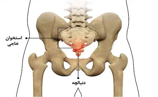 درد دنبالچه 4