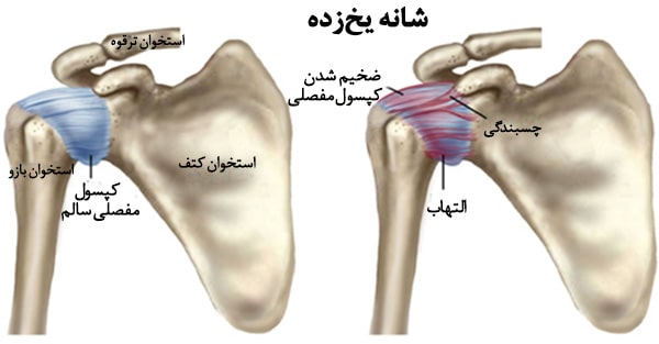 شانه یخ زده 1